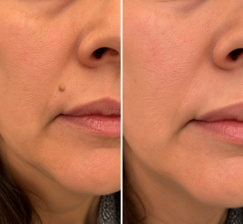 ✨ 2-in-1 Microneedle & Hydrocolloid Patches for Acne & Blemishes | Targeted Face & Body Spot Care