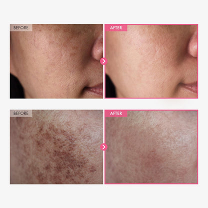 💎 High-Active Brightening Care — 7% Arbutin + 4% TXA Cream