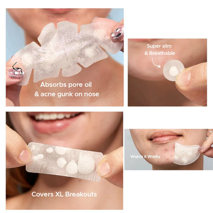 🎁532 Pimple Patches – Hydrocolloid Acne Patches, 5 Sizes, Waterproof Blemish Covers for Face, Nose, Back & Chest