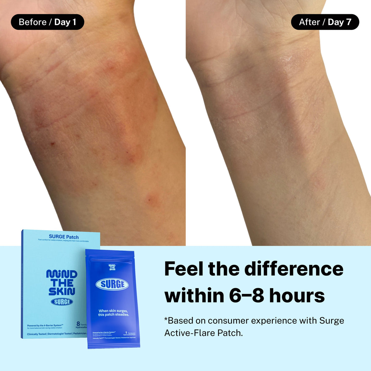 🔥Active Flare Hydrocolloid Patches