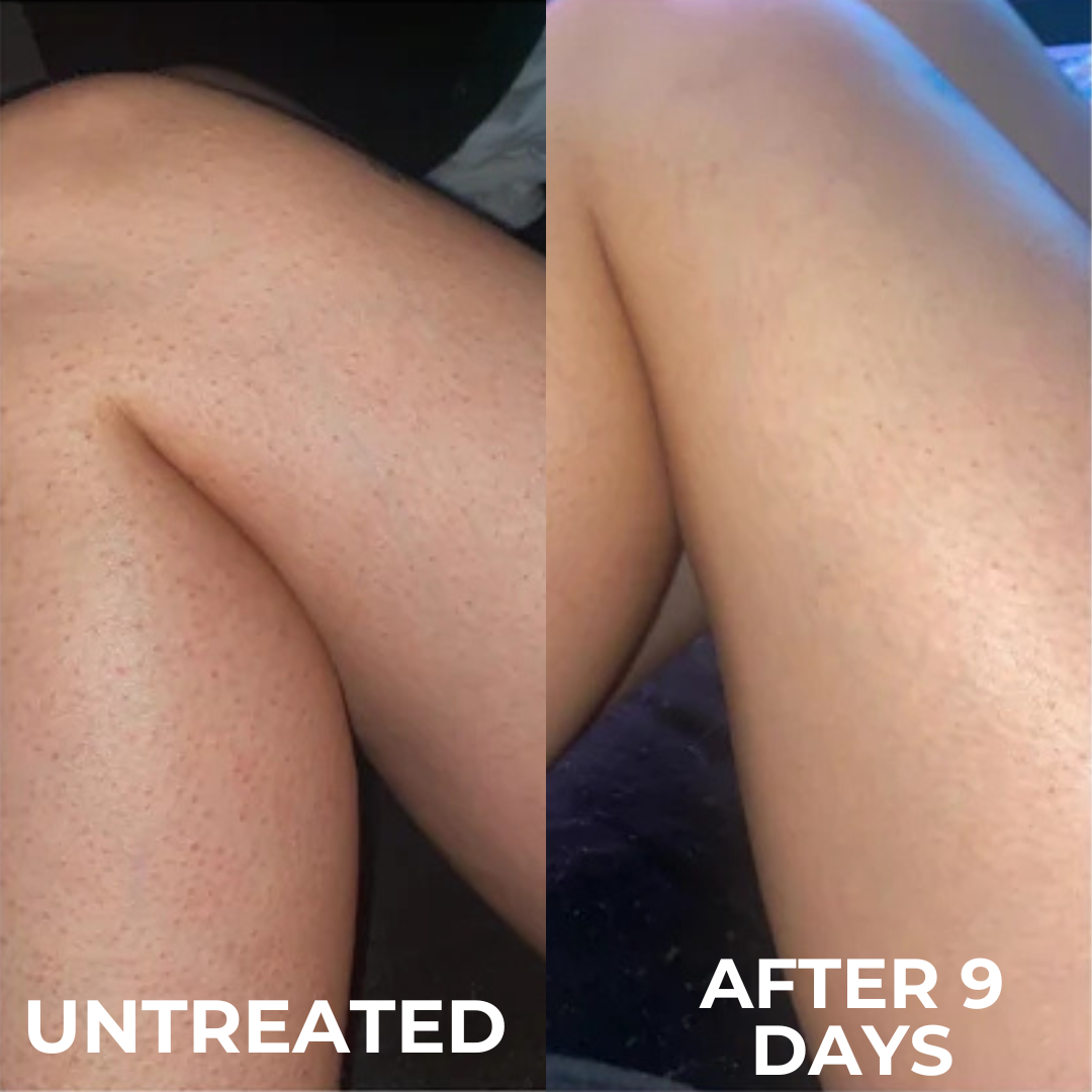 Strawberry Skin Resurfacing Cream – Triple-Acid Complex for Keratosis Pilaris