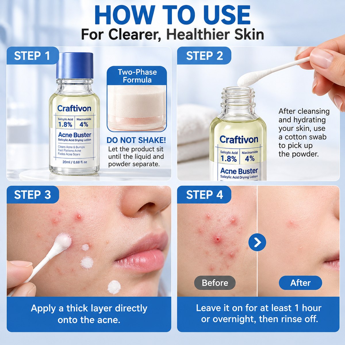 ⭐ 1.8% Salicylic Acid Acne Spot Treatment – Targeted Drying Lotion for Breakouts