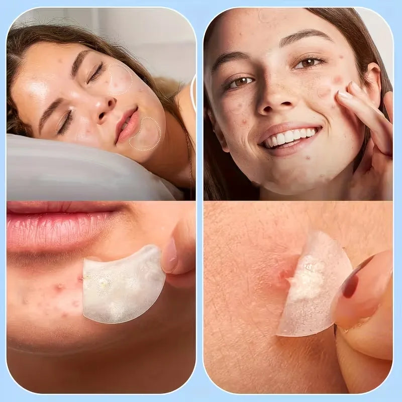 🎁532 Pimple Patches – Hydrocolloid Acne Patches, 5 Sizes, Waterproof Blemish Covers for Face, Nose, Back & Chest