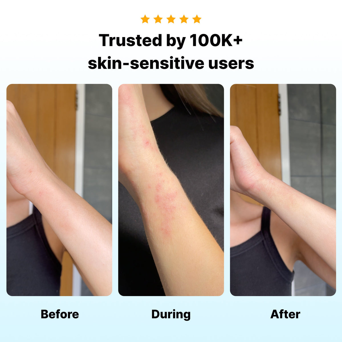 🔥Active Flare Hydrocolloid Patches