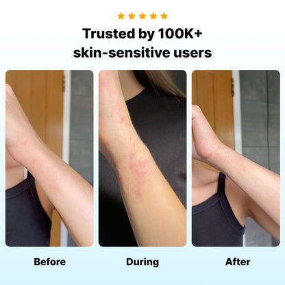 🔥Active Flare Hydrocolloid Patches