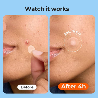 🔥Hydrocolloid Acne Cover Patches