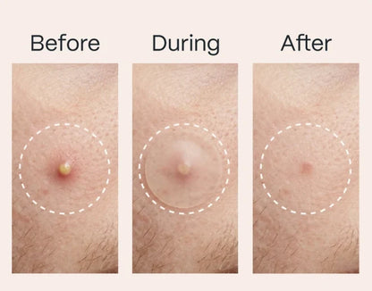 🔥Hydrocolloid Acne Cover Patches
