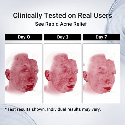 Dr.Leo Acne Buster Salicylic Acid Drying Lotion – Fast-Acting Spot Treatment