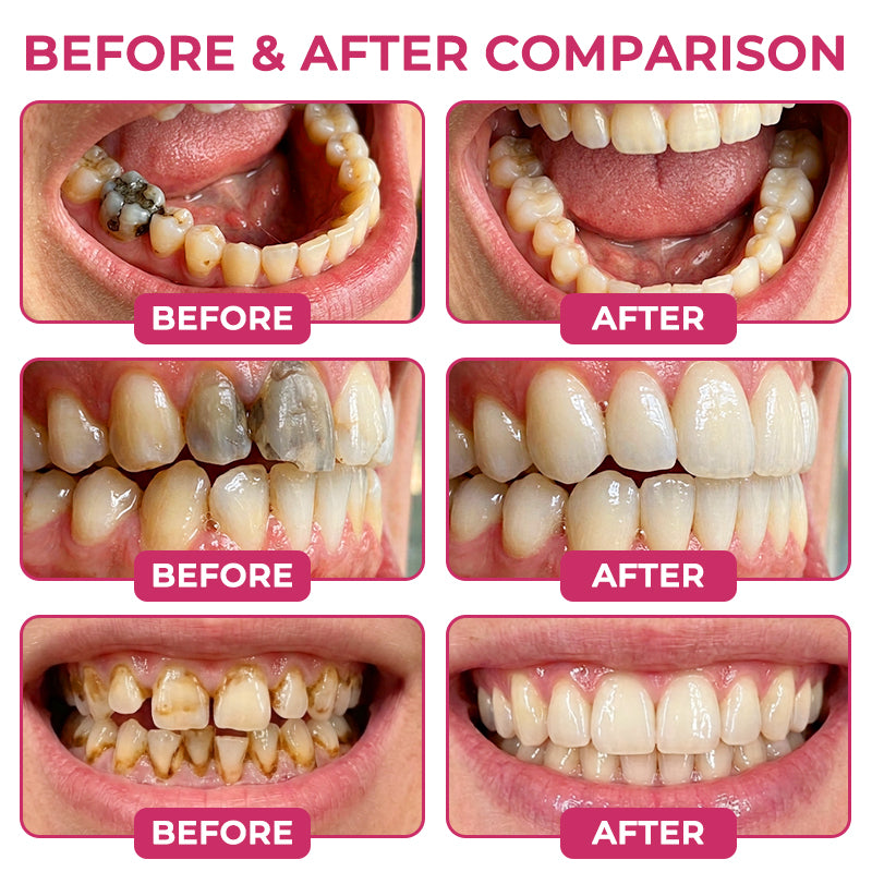 🎀DenPerm Cavity-Repair Natural Enamel Filling Gel