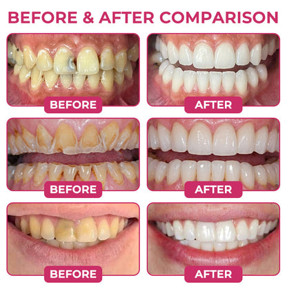 🎀DenPerm Cavity-Repair Natural Enamel Filling Gel