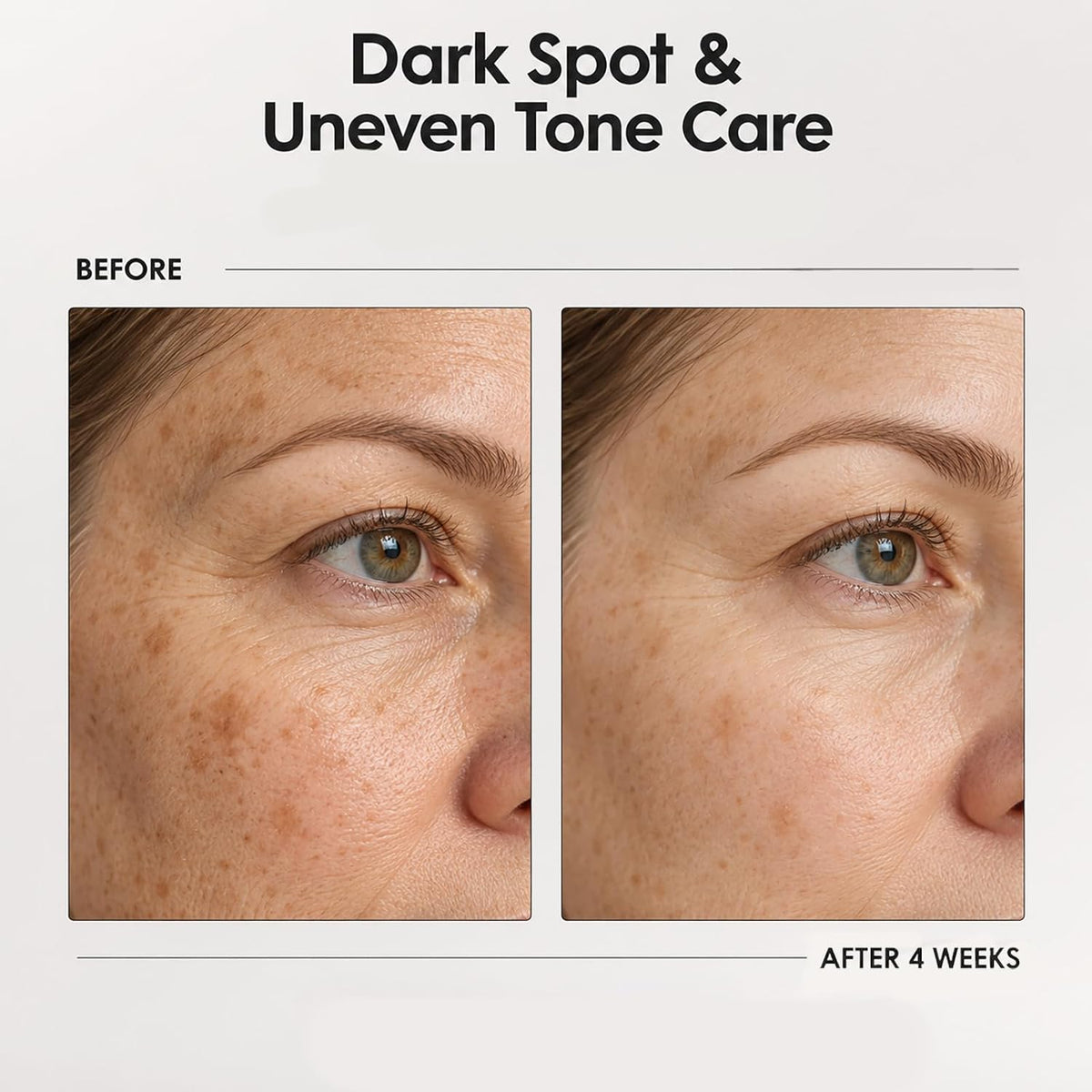 🎉Dark Spot Corrector for Melasma & Hyperpigmentation Brightening Serum for Body-30 mL (1.01 fl oz)