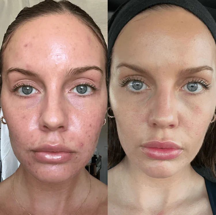 🔥Orange Enzyme Exfoliating Gel