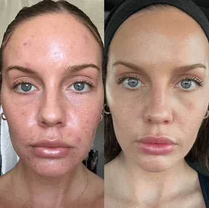 🔥Orange Enzyme Exfoliating Gel