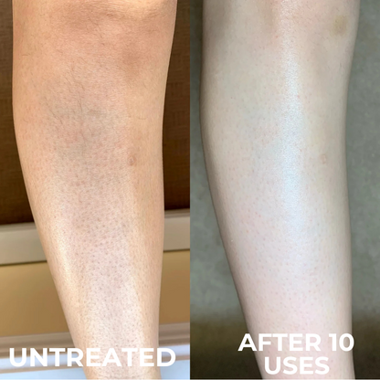 Strawberry Skin Resurfacing Cream – Triple-Acid Complex for Keratosis Pilaris