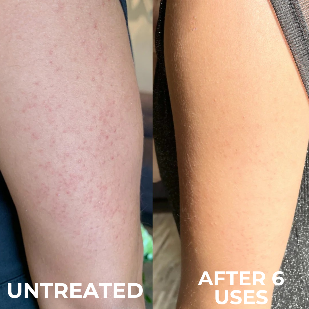 Strawberry Skin Resurfacing Cream – Triple-Acid Complex for Keratosis Pilaris