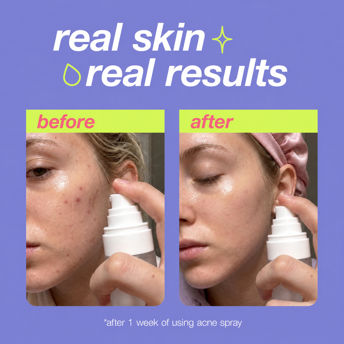 🎉Silkiee Acne Spray