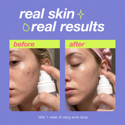 🎉Silkiee Acne Spray
