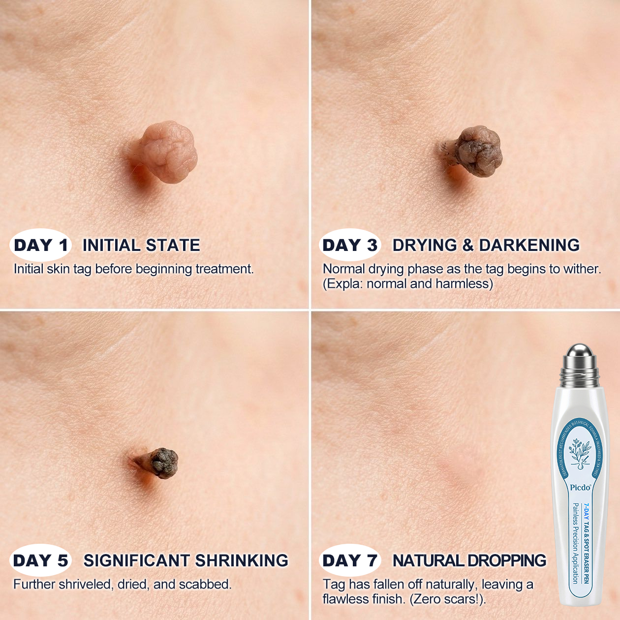 🍁7-𝐷𝑎𝑦 𝗧𝐚𝐠 & 𝗦𝗽𝐨𝐭 𝐄𝐫𝒂𝒔𝒆𝒓（Zero Pain. Zero Scars Rollerball）
