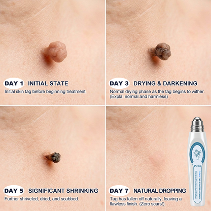 🍁7-𝐷𝑎𝑦 𝗧𝐚𝐠 & 𝗦𝗽𝐨𝐭 𝐄𝐫𝒂𝒔𝒆𝒓（Zero Pain. Zero Scars Rollerball）