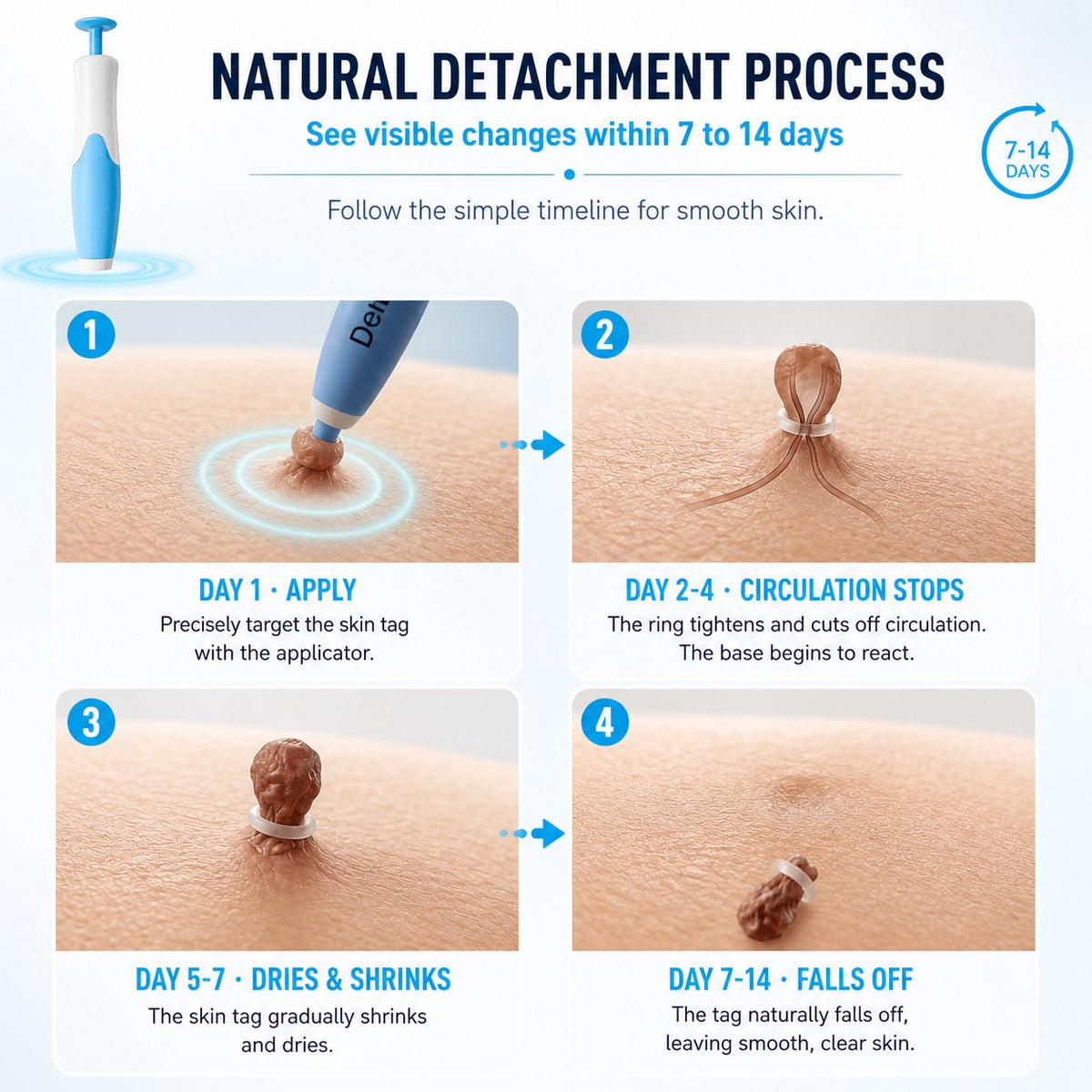 Painless removal kit for skin growths